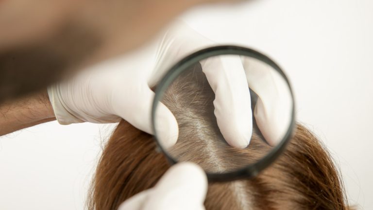 What Does Each Stage of Head Lice Look Like?