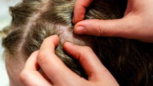 What Are the Earliest Signs You Might Have Head Lice?