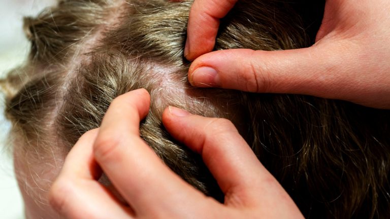 What Are the Earliest Signs You Might Have Head Lice?