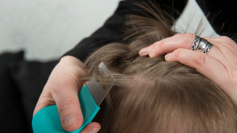 Not Every White Speck in the Hair Is a Lice Egg
